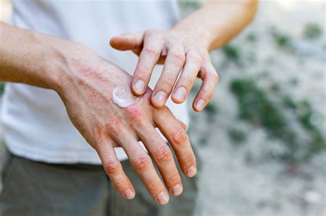Jak leczyć zapalenie skóry Dühringa